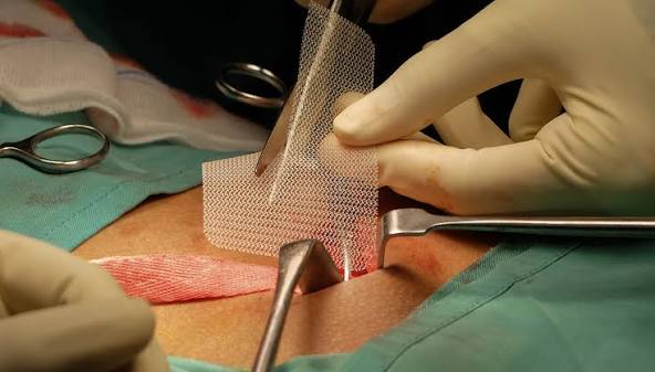 What Is Hernia Repair Surgery Abu Dhabi and Why Should You Consider Early Treatment?