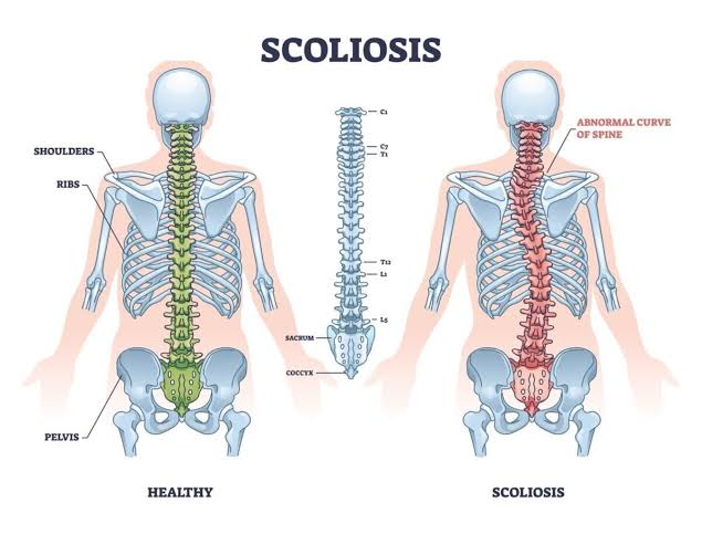 How Can the Right Scoliosis Treatment Improve Your Spine Health and Quality of Life?
